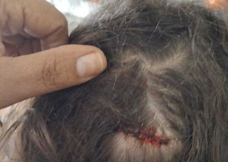 Menina de 7 anos é atingida na cabeça por bala perdida enquanto dormia em MS